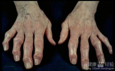 手脚麻和风湿病有关系？这个问题别忽视